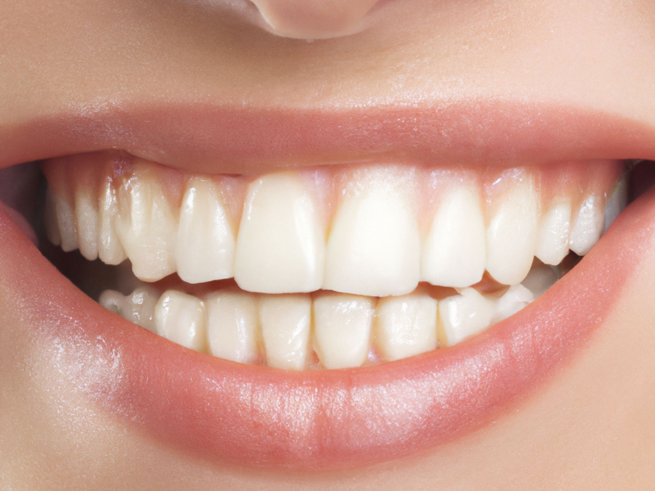 Bright, healthy white teeth after professional whitening treatment